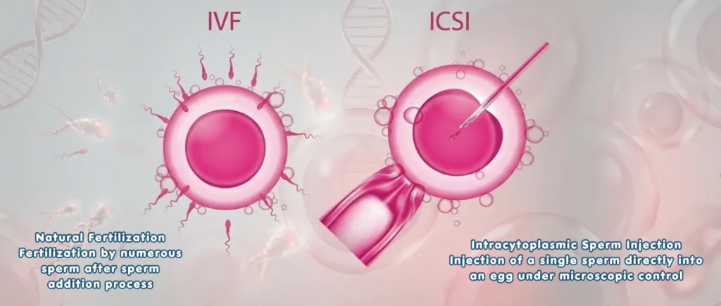 IVF vs ICIS blog